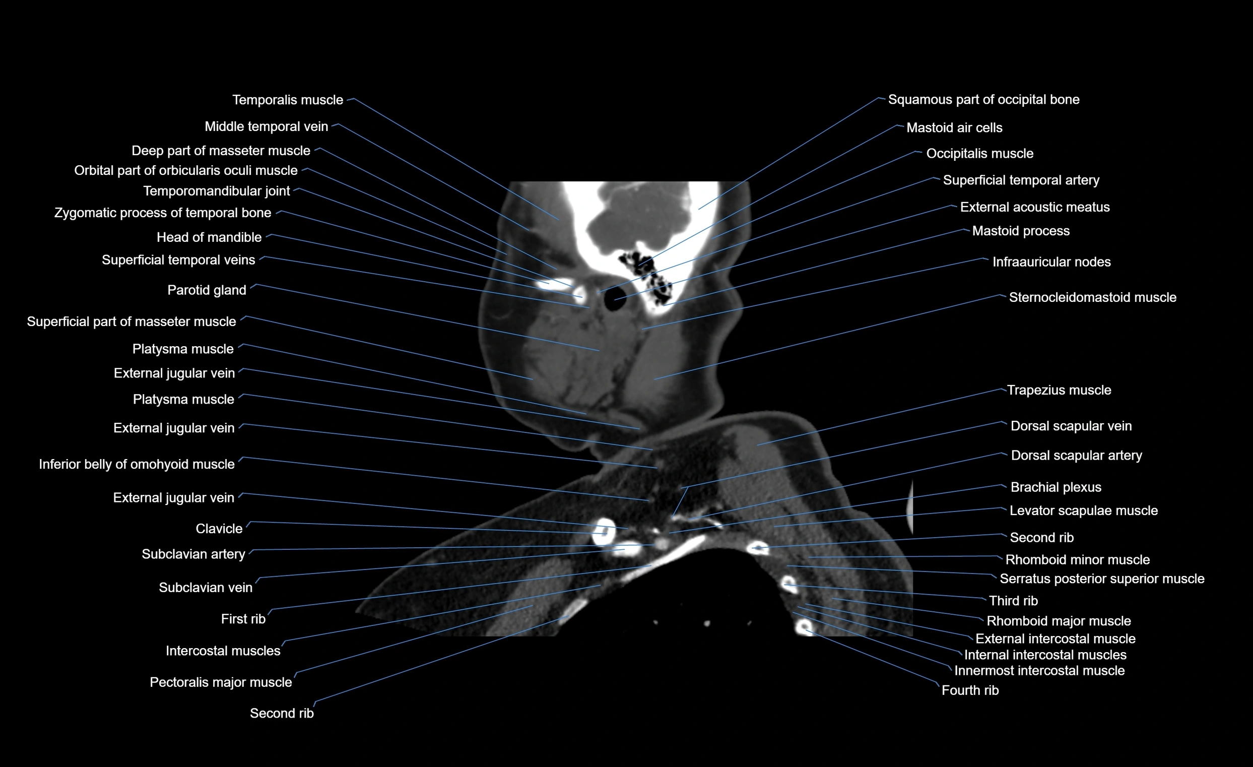 Neck CT sagittal cross sectional anatomy 3D  radiology  image-img-00001-00022.webp